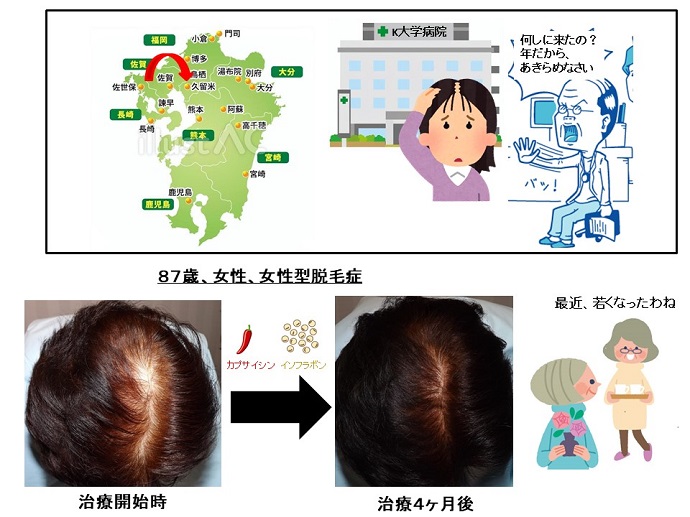 円形脱毛症　病院